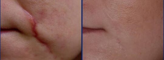 Cleft_palate-2